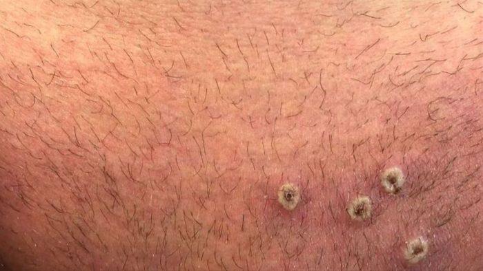  Salud Pública notifica otros dos casos de viruela del mono en el país